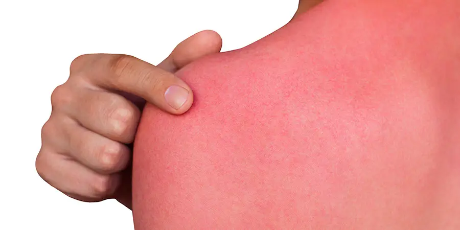 A Man's back with reddened itchy skin after sunburn