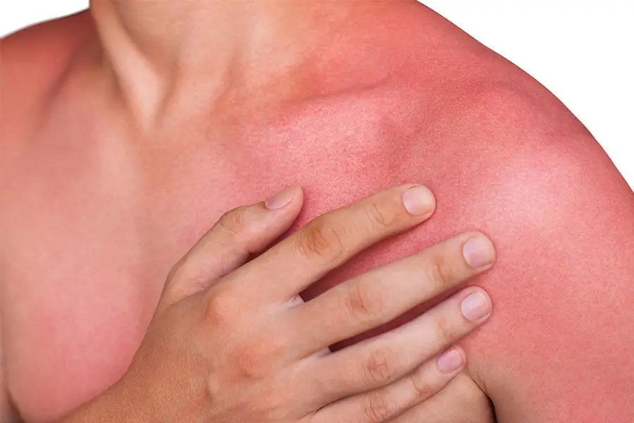 A man with reddened itchy skin after sunburn